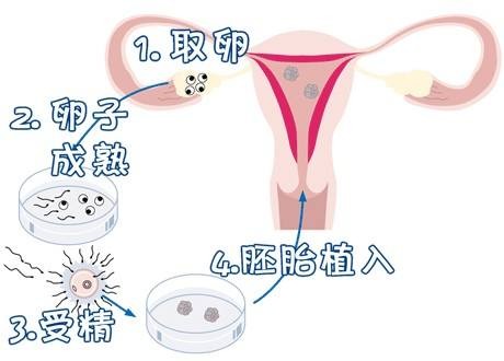 关于代生包成功代妈补偿